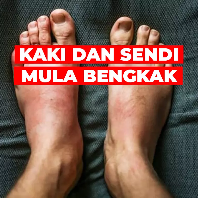 kaki-bengkak